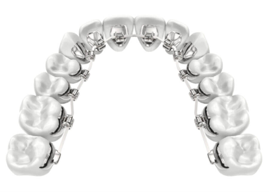 Lingual Braces